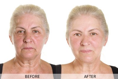 Before-After-4-f
